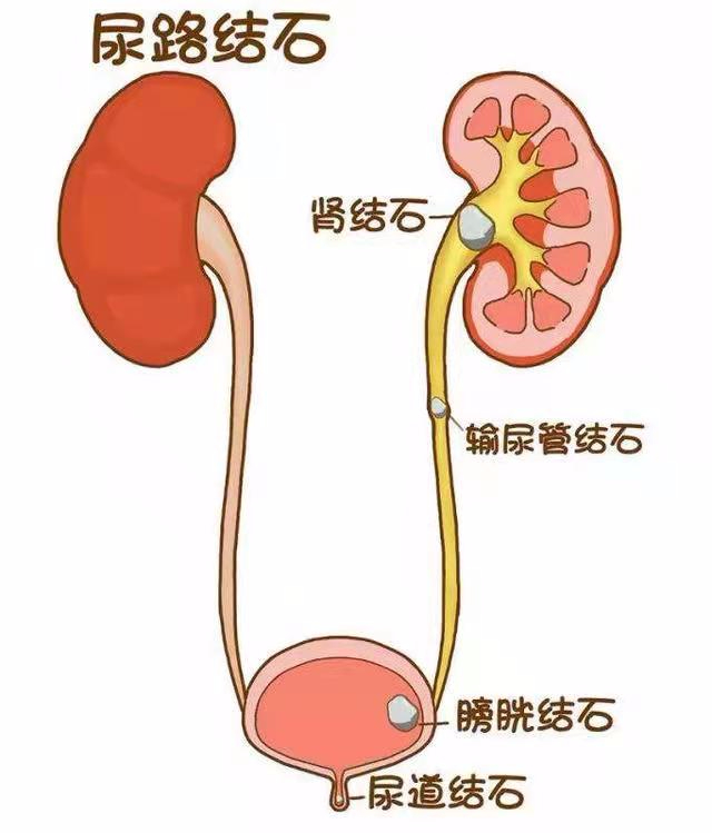 “吃”出来的结石，这些食物再好吃也要节制，管住嘴巴（转发今日头条）