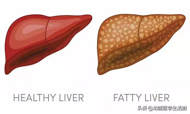 得了脂肪肝别害怕，改变饮食结构，助你甩掉脂肪肝（转发今日头条）