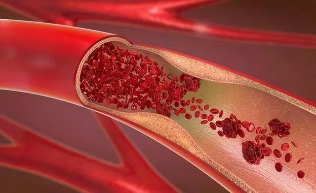哪些食物会“加速”血管堵塞呢？(转发今日头条）